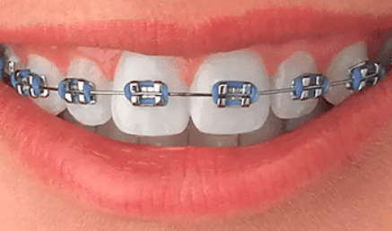 The Different Types of Braces Explained